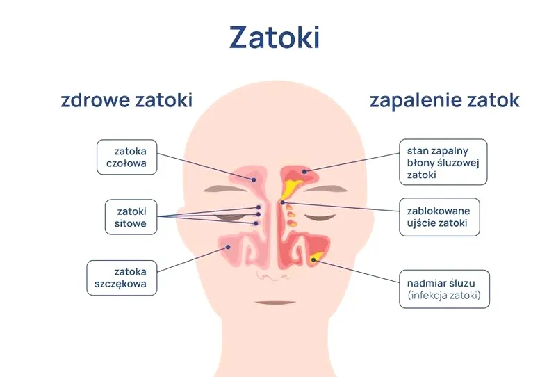 Zapalenie zatok – czy to czas na pozostanie w domu?