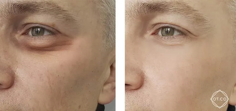 Cena zabiegu worki pod oczami